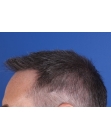 After Hair Transplant&nbsp;2 Sessions (Areas)